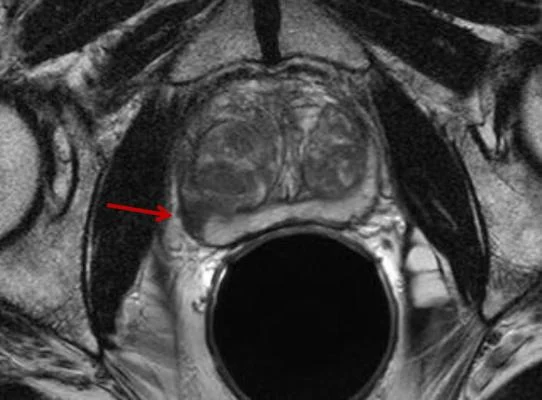 MRI gruczołu krokowego